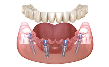 Dental Implants Being Fitted
