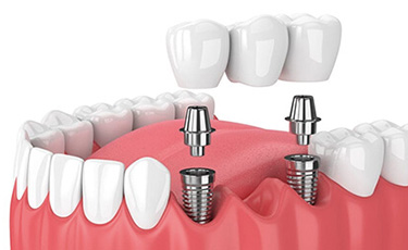 Dental Implants During Procedure