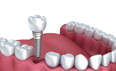Dental Implants Being Fitted In Cartoon Image