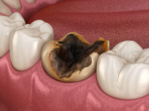 Damaged Decayed Tooth