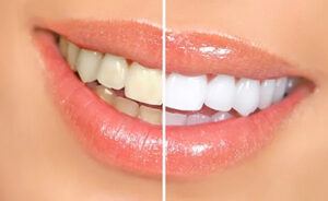 Lady Smiling After Having Dental Bleaching Teeth Whitening Treatment In Turkey