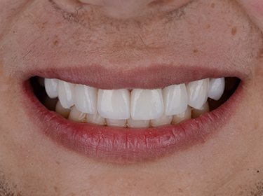 Laminate Veneers Teeth Coating