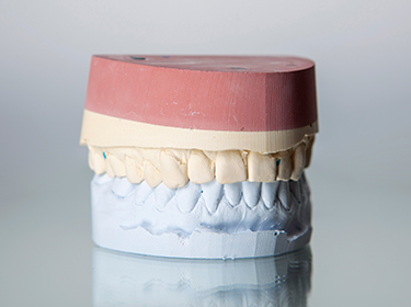 Mold of Teeth For Laminate Veneers